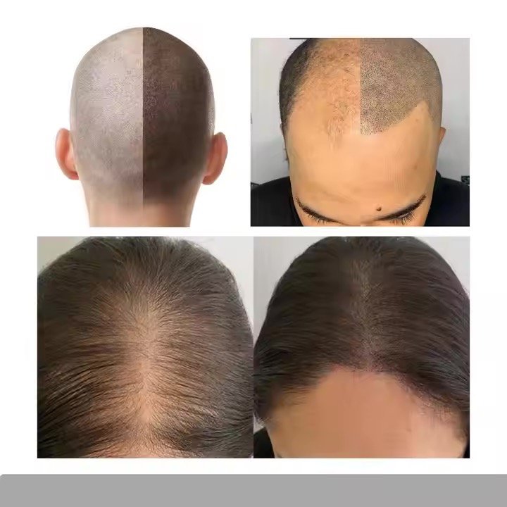 Specially formulated Scalp Micropigmentation Ink for the scalp, made from pure plant extracts that are safely metabolized by the body with no harm to health